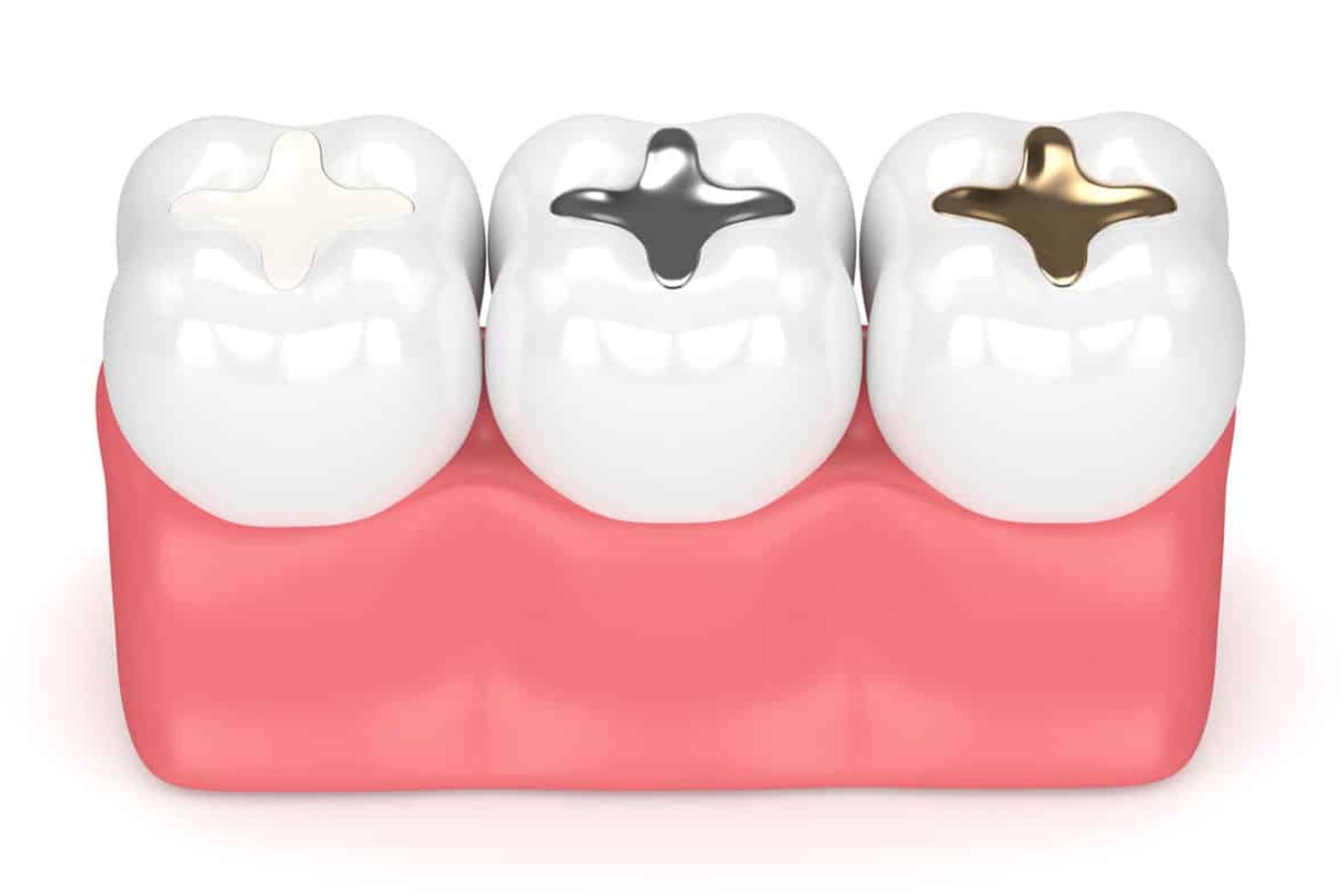 Tooth Filler Types Malar Dental
